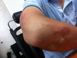 joint injury